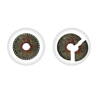 artificialiris-customflex-iris-implant-aniridia-trephine-adapt-size-form-with-fiber-fiber-free-humanoptics