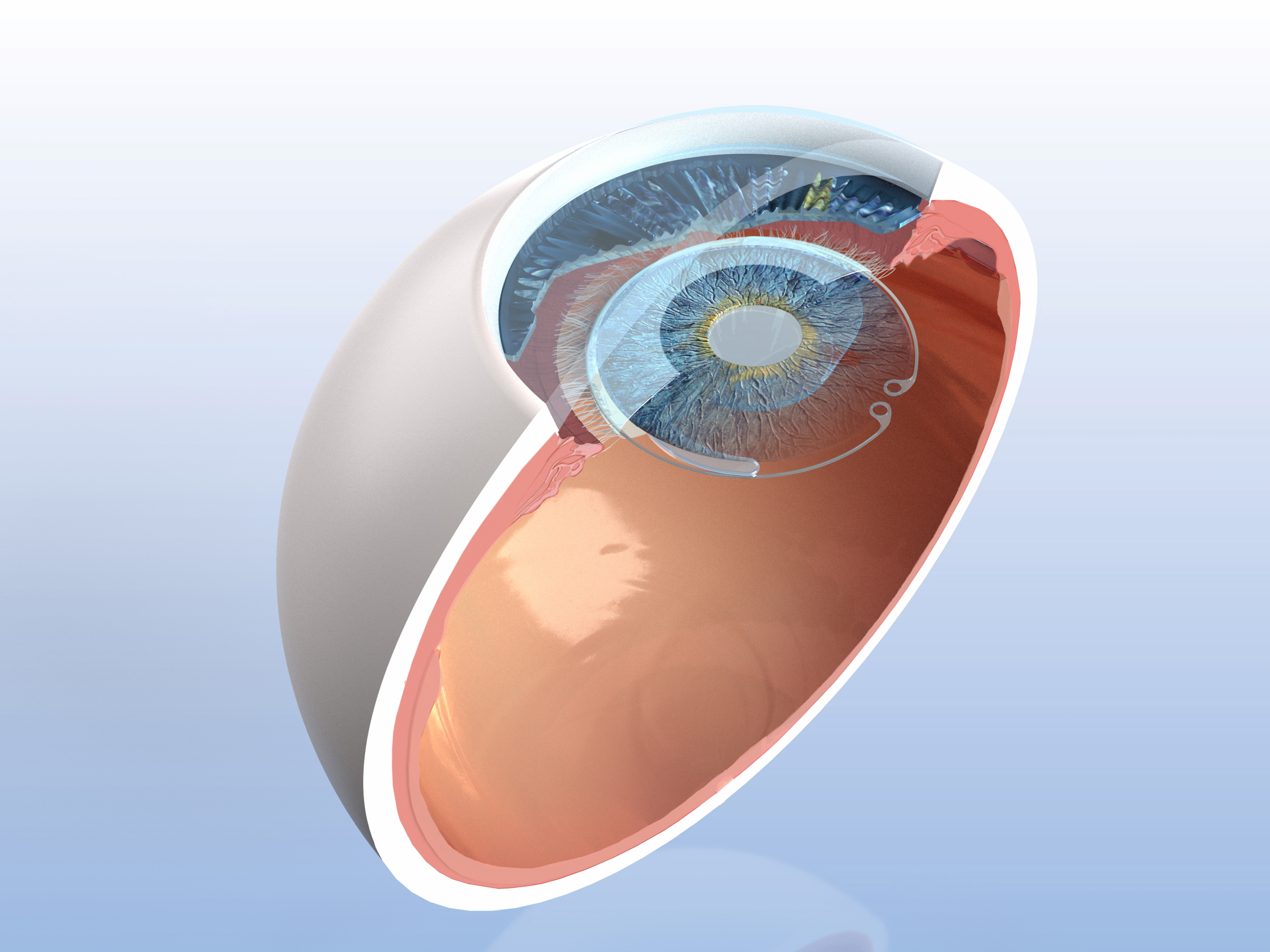 Capsular Tension Ring With Scleral Fixation Arm - Ophthalmic