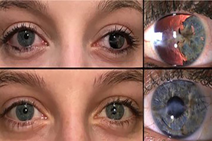 💪 Stärkung Ihrer Kompetenz im Bereich der Irisrekonstruktion. © Dr. Michael E. Snyder, MD at Cincinnati Eye Institute, Juli 2019.