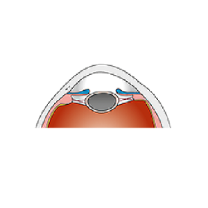 Human-optics-Grauer-Star-linsenaustausch-1